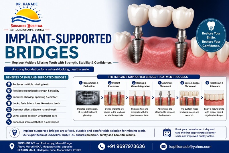 Implant-Supported Bridges